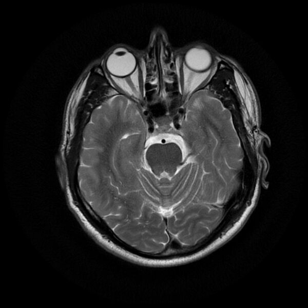 File:Acoustic schwannoma - intracanalicular (Radiopaedia 37247-39024 Axial T2 8).jpg