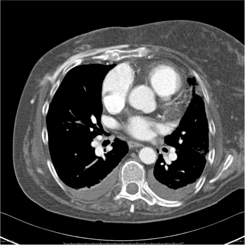 Acute-on-chronic pulmonary emboli (Radiopaedia 27925-28169 C+ CTPA 44).jpg