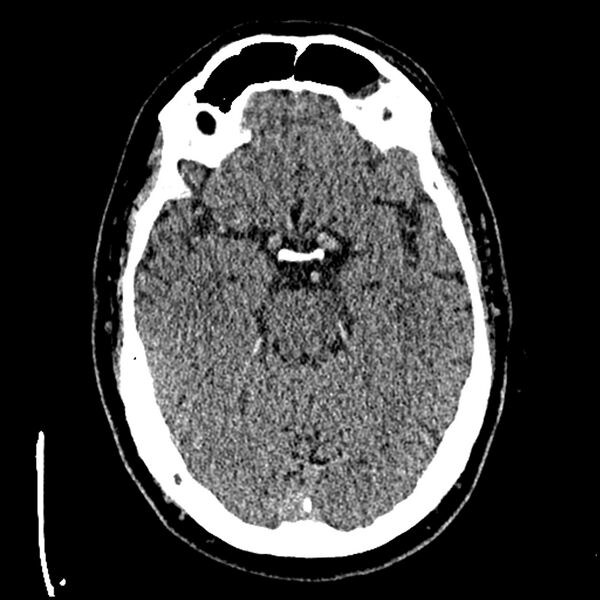 File:Acute A3 occlusion with ACA ischemic penumbra (CT perfusion) (Radiopaedia 72036-82525 Axial non-contrast thins 2).jpg