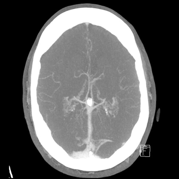 File:Acute A3 occlusion with ACA ischemic penumbra (CT perfusion) (Radiopaedia 72036-82527 Axial 10 sec delay thick MIP 8).jpg