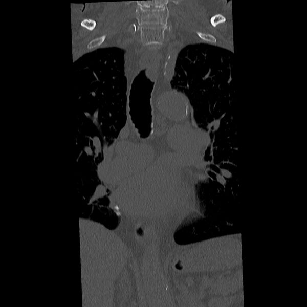 File:Acute and chronic vertebral compression fractures (Radiopaedia 31608-32494 Coronal bone window 1).jpg