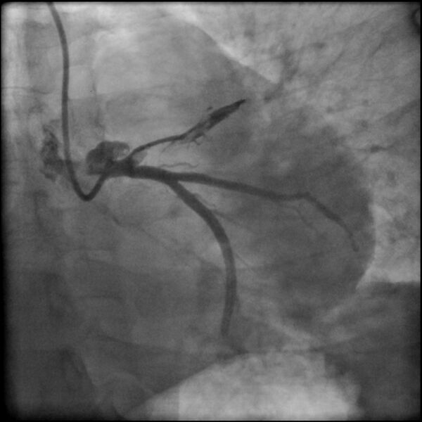 File:Acute anteroseptal myocardial infarction (Radiopaedia 68409-77946 LAO caudal (spider view) LAD and CX 18).jpg