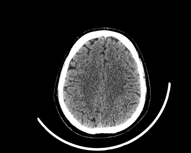 File:Acute cerebral infarct (Radiopaedia 35604-37123 Axial non-contrast 73).jpg