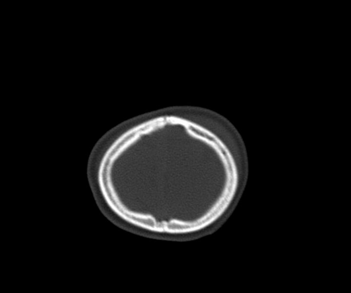 File:Acute epidural hematoma (Radiopaedia 63659-72335 Axial bone window 33).jpg