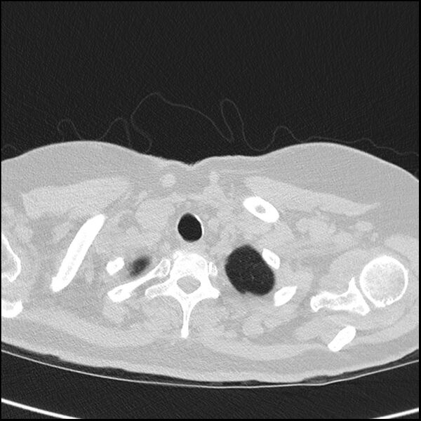 File:Acute interstitial pneumonitis (Radiopaedia 45404-49453 Axial lung window 6).jpg