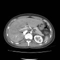 Acute myocarditis (Radiopaedia 55988-62613 Axial C+ portal venous phase 22).jpg