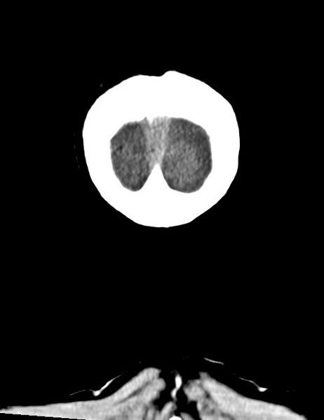 File:Acute on chronic subdural hematoma (Radiopaedia 74814-85823 Coronal non-contrast 62).jpg
