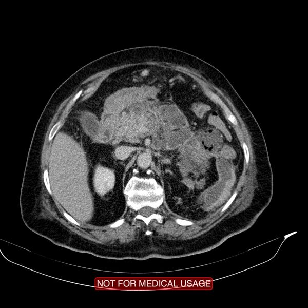 File:Acute pancreatitis with infected necrosis (Radiopaedia 26454-26585 Axial C+ delayed 12).jpg