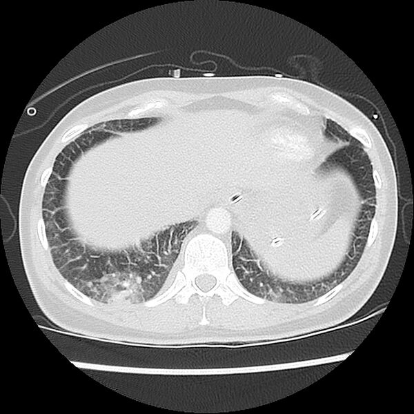 File:Acute pulmonary edema on CT (Radiopaedia 33582-34672 Axial lung window 46).jpg