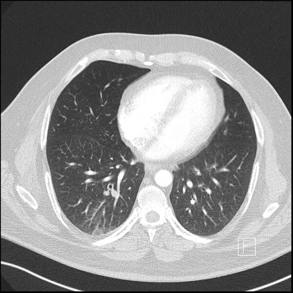 File:Acute pulmonary embolism with pulmonary infarct (Radiopaedia 73062-83768 Axial lung window 7).jpg