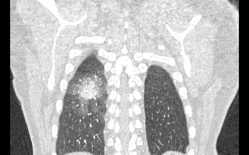 File:Acute pulmonary embolism with pulmonary infarcts (Radiopaedia 77688-89908 Coronal lung window 92).jpg