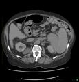 Acute renal failure post IV contrast injection- CT findings (Radiopaedia 47815-52559 Axial C+ portal venous phase 31).jpg
