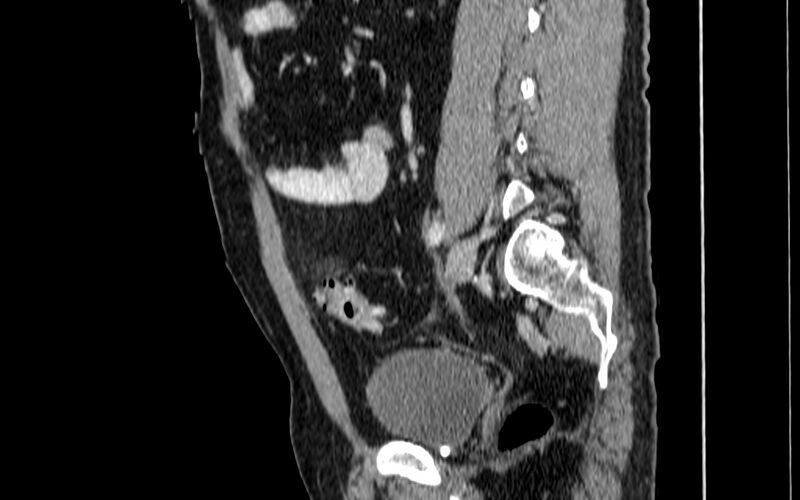 File:Acute sigmoid colon diverticulitis (Radiopaedia 55507-61976 Sagittal C+ portal venous phase 35).jpg