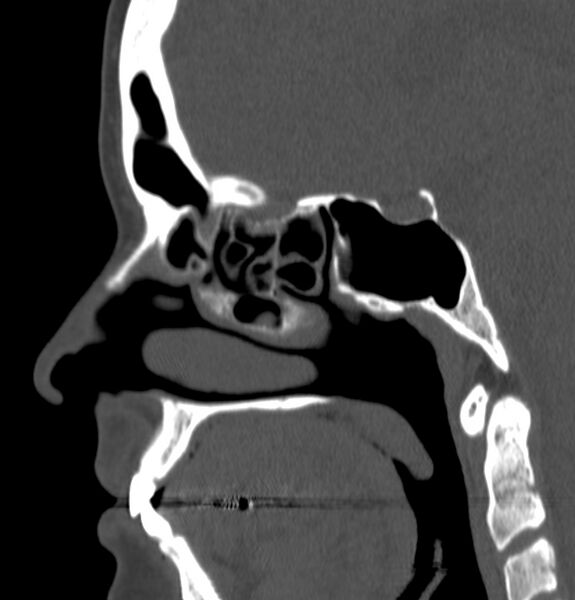 File:Acute sinusitis (Radiopaedia 22419-22455 Sagittal non-contrast 12).jpg