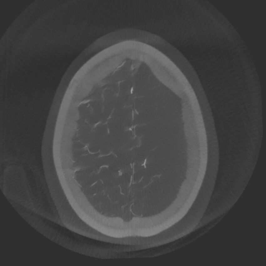 Acute subarachnoid hemorrhage and accessory anterior cerebral artery (Radiopaedia 69231-79010 Axial arterial - MIP 74).jpg
