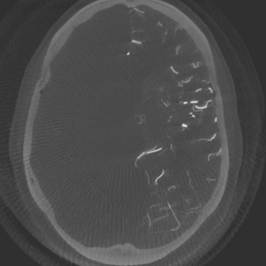 Acute subarachnoid hemorrhage and accessory anterior cerebral artery (Radiopaedia 69231-79010 C 33).jpg