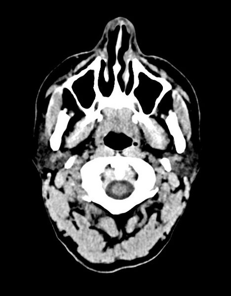 File:Acute superior cerebellar artery territory infarct (Radiopaedia 84104-99359 Axial non-contrast 67).jpg