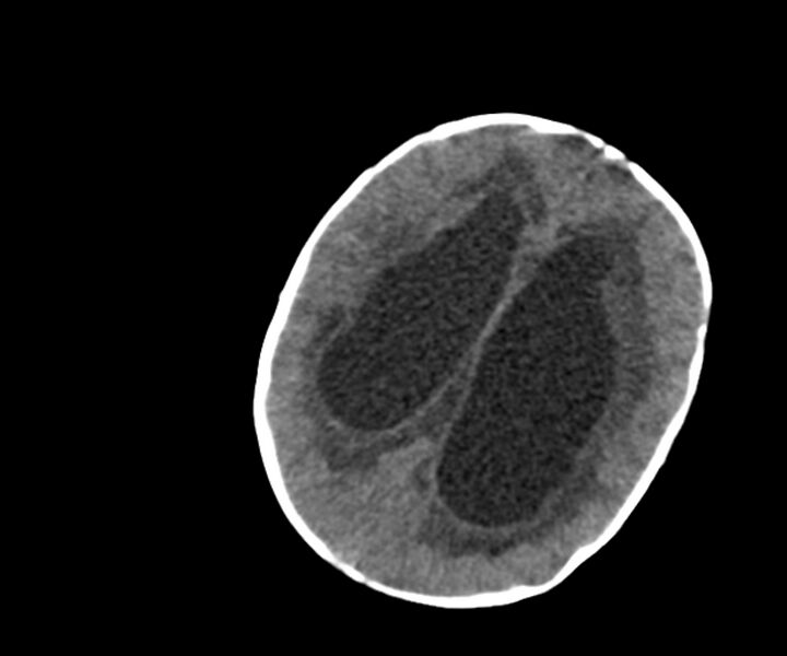 File:Acute ventriculitis (Radiopaedia 57502-64459 Axial non-contrast 12).jpg