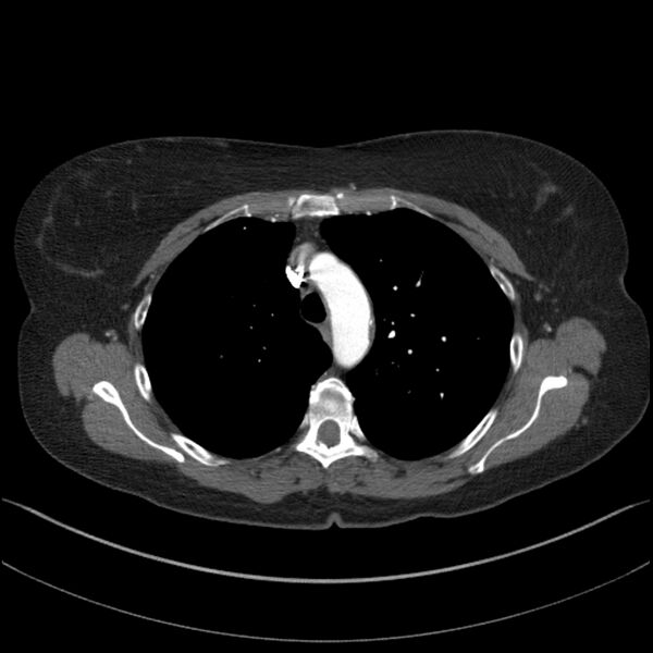File:Adenocarcinoma of the lung (Radiopaedia 44205-47803 Axial C+ portal venous phase 25).jpg