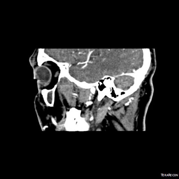 File:Adenoid cystic carcinoma involving paranasal sinus (Radiopaedia 16580-16283 Sagittal C+ arterial phase 14).jpeg