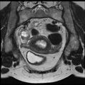 Adenoma malignum of the cervix (Radiopaedia 24460-24765 Coronal T2 8).jpg