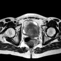 Adenomyoma of the uterus (huge) (Radiopaedia 9870-10438 Axial T2 11).jpg
