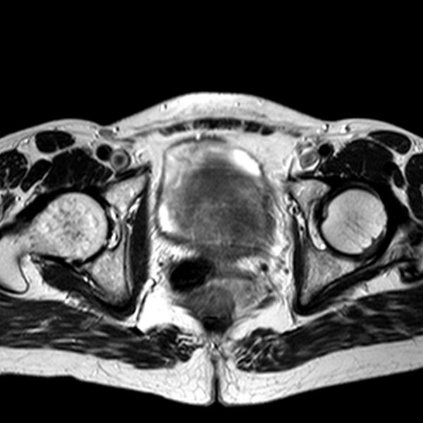 File:Adenomyoma of the uterus (huge) (Radiopaedia 9870-10438 Axial T2 11).jpg