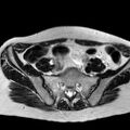 Adenomyoma of the uterus (huge) (Radiopaedia 9870-10438 Axial T2 33).jpg