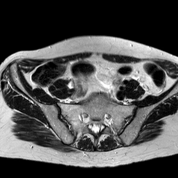File:Adenomyoma of the uterus (huge) (Radiopaedia 9870-10438 Axial T2 33).jpg