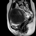 Adenomyoma of the uterus (huge) (Radiopaedia 9870-10438 Sagittal T2 12).jpg
