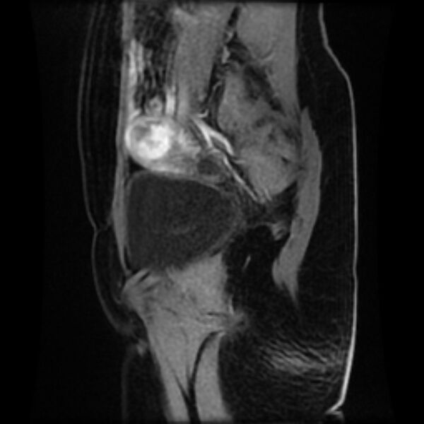 File:Adenomyosis within a septate uterus (Radiopaedia 69963-79981 Sagittal LAVA-Dyn 7).jpg
