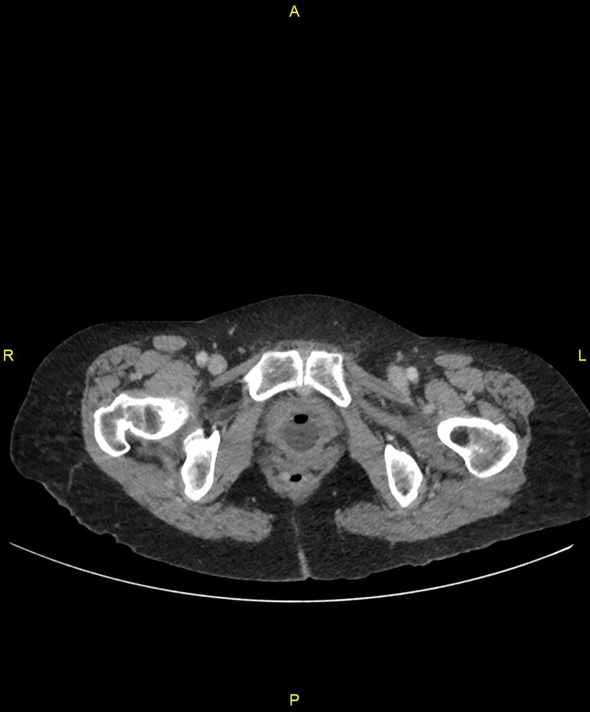 Adhesional small bowel obstruction (Radiopaedia 85402-101024 Axial C+ portal venous phase 289).jpg