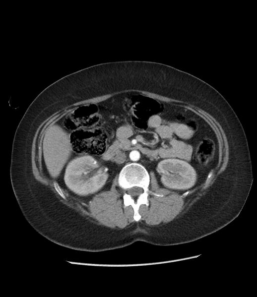 File:Adrenal cortical carcinoma with IVC invasion and thrombosis (Radiopaedia 34307-35597 Axial C+ arterial phase 39).jpg
