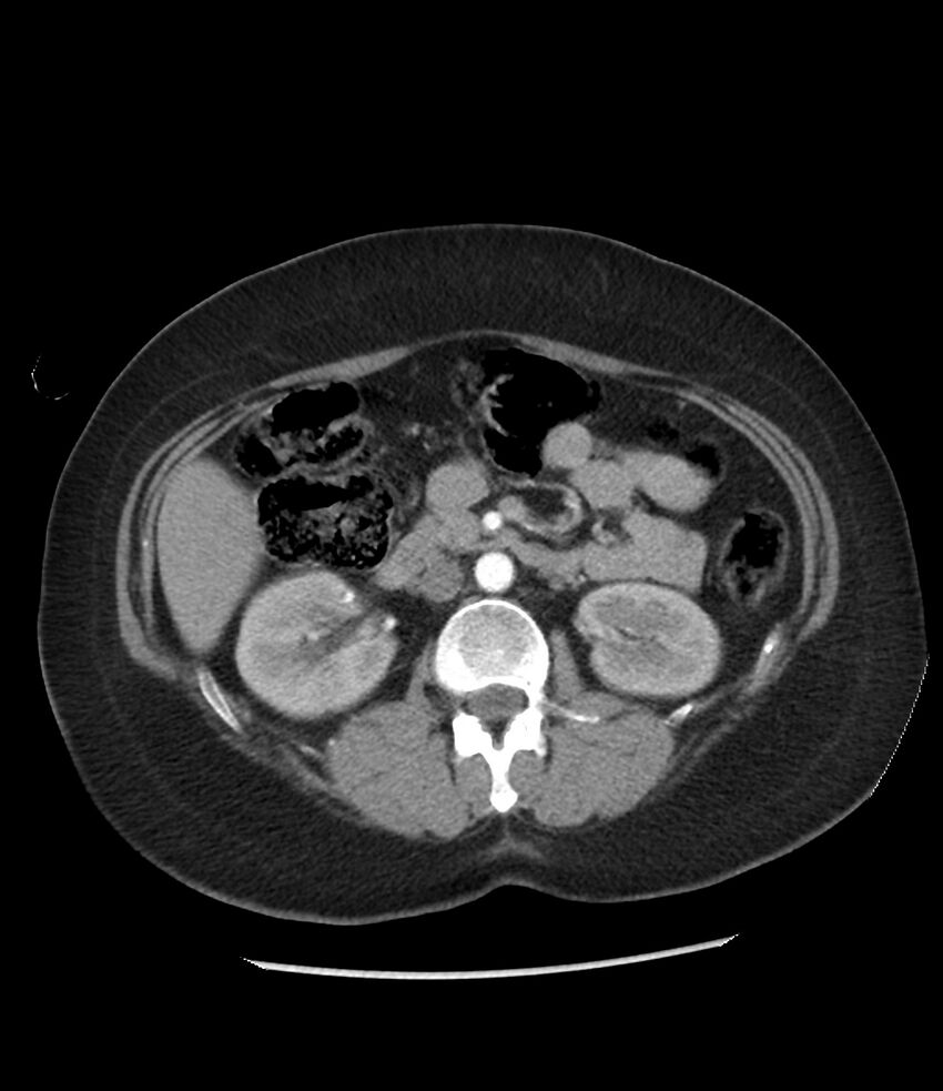 Adrenal cortical carcinoma with IVC invasion and thrombosis (Radiopaedia 34307-35597 Axial C+ arterial phase 39).jpg