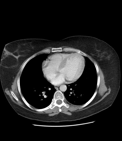 File:Adrenal cortical carcinoma with IVC invasion and thrombosis (Radiopaedia 34307-35597 Axial C+ portal venous phase 3).jpg