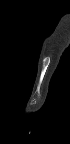 File:Advanced osteomyelitis due to open metatarsal fracture (Radiopaedia 83891-99095 C 21).jpg