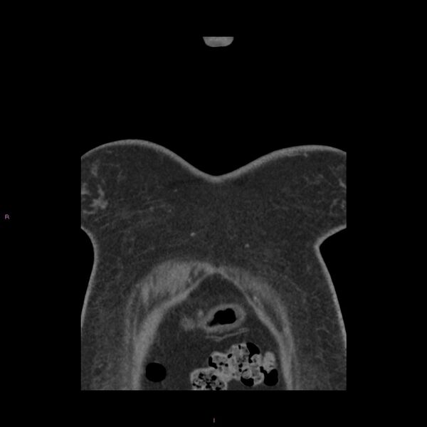 File:Agenesis of the left hepatic lobe (Radiopaedia 77284-89359 Coronal C+ CTPA 80).jpg
