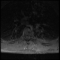 Aggressive vertebral hemangioma (Radiopaedia 39937-42404 Axial T1 C+ fat sat 23).png