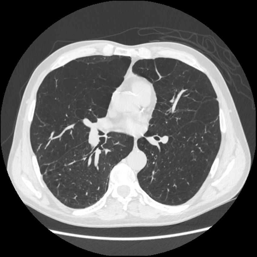 Alpha-1-antitrypsin deficiency (Radiopaedia 40993-43722 Axial lung window 127).jpg