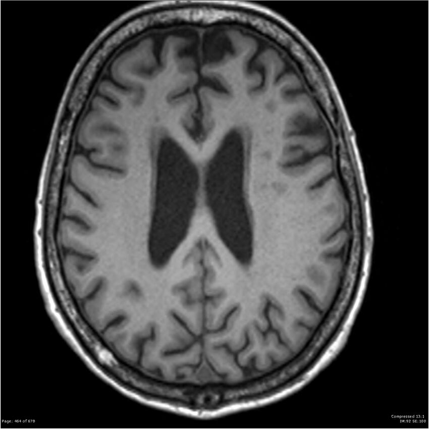 Alzheimer disease (Radiopaedia 22196-22226 Axial T1 42).jpg