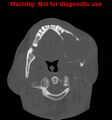 Ameloblastoma (Radiopaedia 13276-13280 Axial non-contrast 11).jpg