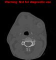Ameloblastoma (Radiopaedia 13276-13280 Axial non-contrast 2).jpg