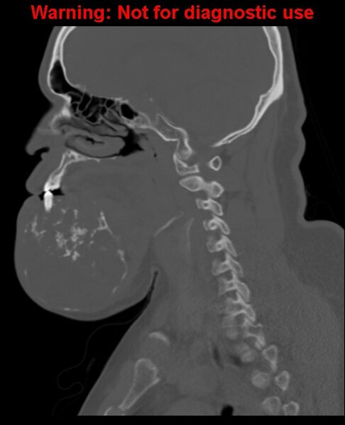 File:Ameloblastoma (Radiopaedia 33126-34164 Sagittal bone window 36).jpg