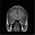 Amnestic syndrome secondary to hypoxic brain injury (Radiopaedia 24743-25004 B 19).jpg