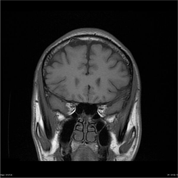 File:Amnestic syndrome secondary to hypoxic brain injury (Radiopaedia 24743-25004 B 19).jpg
