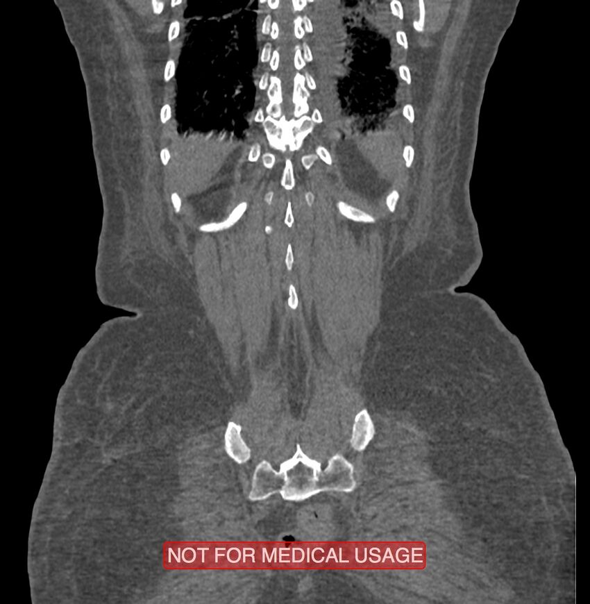 Amoebic enterocolitis with liver abscess (Radiopaedia 35100-36609 B 184).jpg