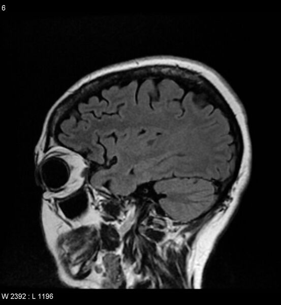 File:Amyotrophic lateral sclerosis (Radiopaedia 5373-7134 Sagittal FLAIR 2).jpg