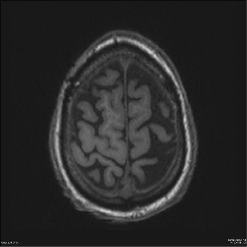 Anaplastic meningioma with recurrence (Radiopaedia 34452-35788 Axial T1 124).jpg