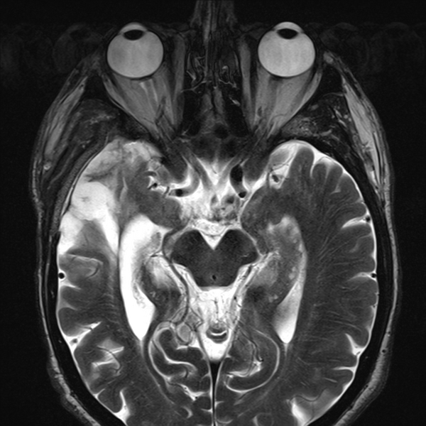 File:Anaplastic meningioma with recurrence (Radiopaedia 34452-35788 Axial T2 8).png