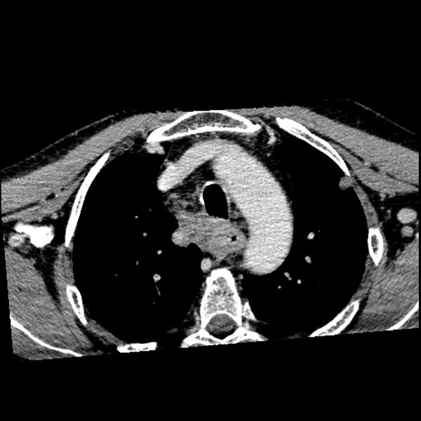 File:Anaplastic thyroid carcinoma (Radiopaedia 79087-92034 B 9).jpg